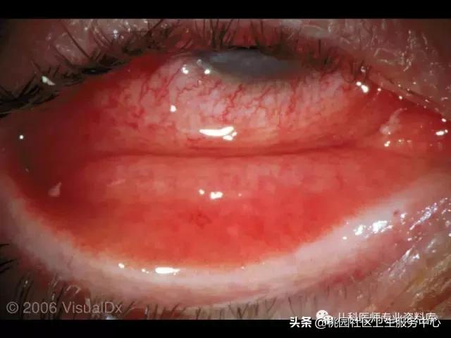 过敏性鼻炎手术的全过程,治疗过敏性鼻炎有效的药