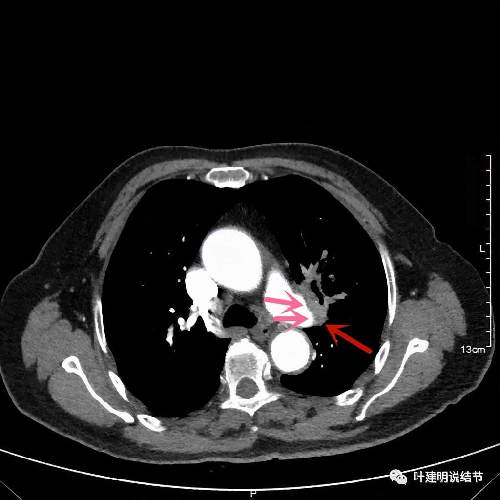 卡瑞利珠单抗治疗肺鳞癌有用吗,特瑞普利单抗对鳞癌治疗有效吗