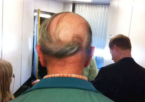 秃如其来怎么办,斑秃后怎么激发黑色毛囊细胞