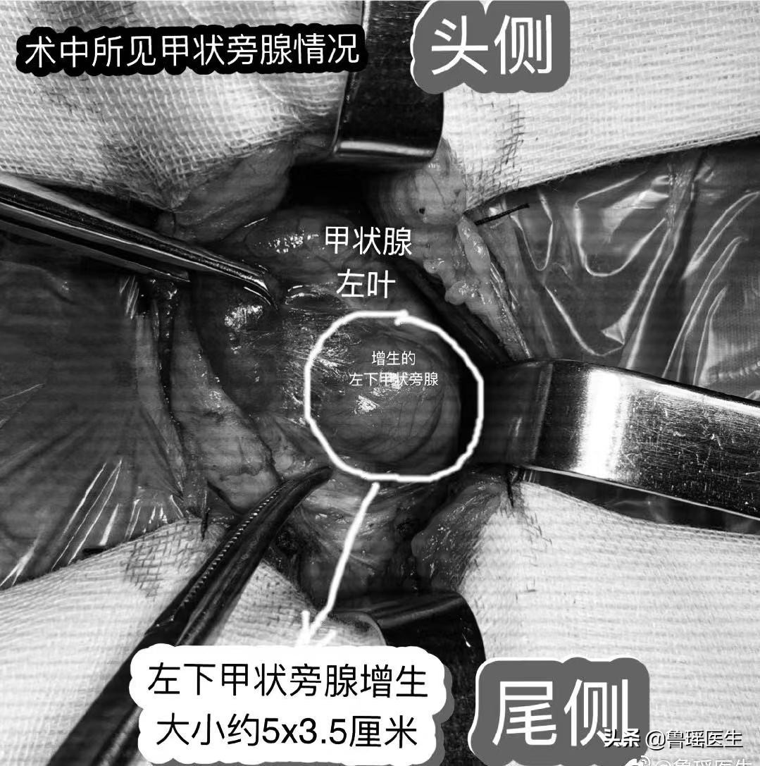 尿道结石会导致腹胀消化不良吗,关节炎和尿路结石是什么代谢异常