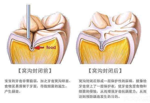 已经有龋齿了还可以做窝沟封闭吗,幼儿龋齿窝沟封闭护理措施