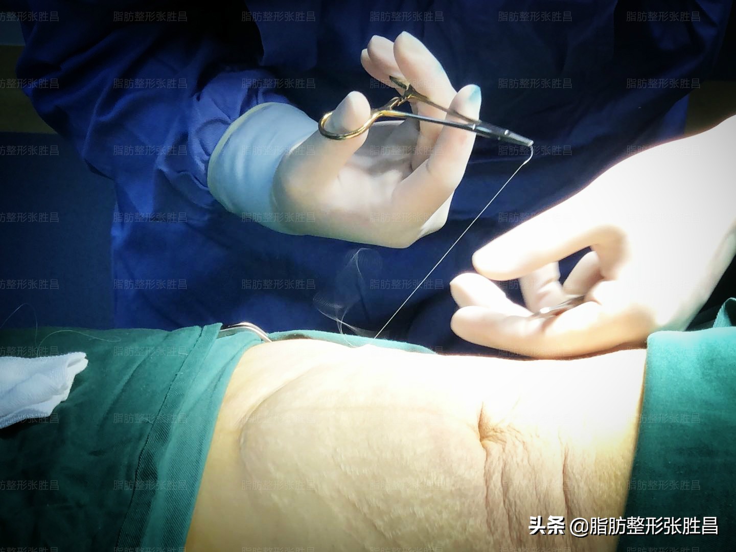 吸脂手术的疤痕怎么消除,吸脂针眼可以激光去除吗