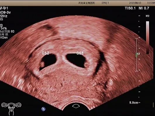 经阴超声检查会不会感染,阴式超声检查会影响胎儿吗