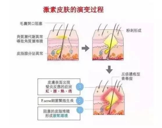 激素脸抹的什么药膏,激素脸涂什么药膏
