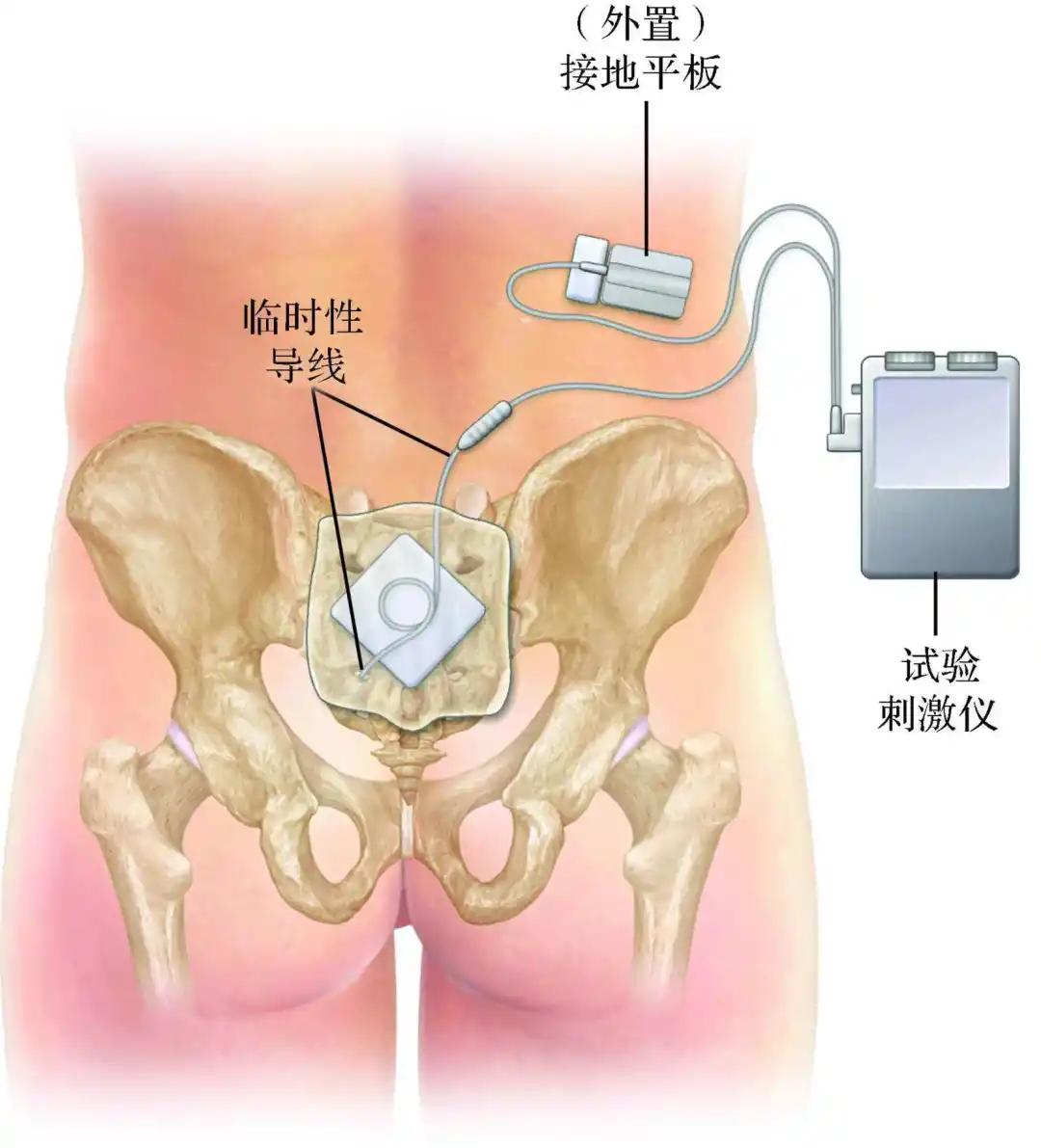 直肠癌保肛术后排大便困难怎么办,直肠癌保肛术后排便困难怎么回事