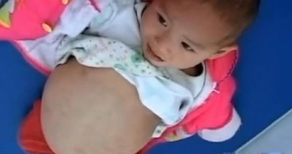 1岁半女童身怀9斤“胎儿”,手术医生刚打开肚子:自己就跳出来了