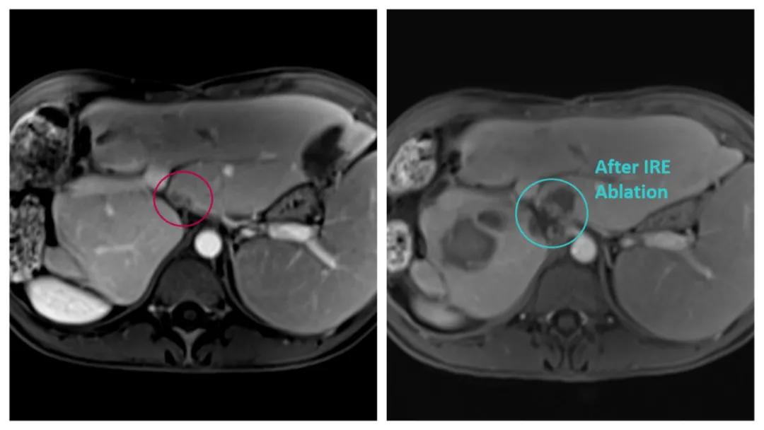 新一代不可逆电穿孔设备|赛诺微在欧洲完成首例IRE手术
