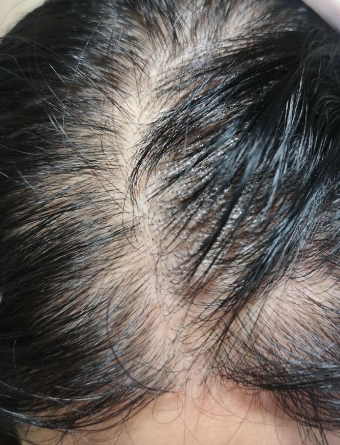 七宝美髯丹是治掉头发吗,掉头发吃七宝美髯丹管用吗