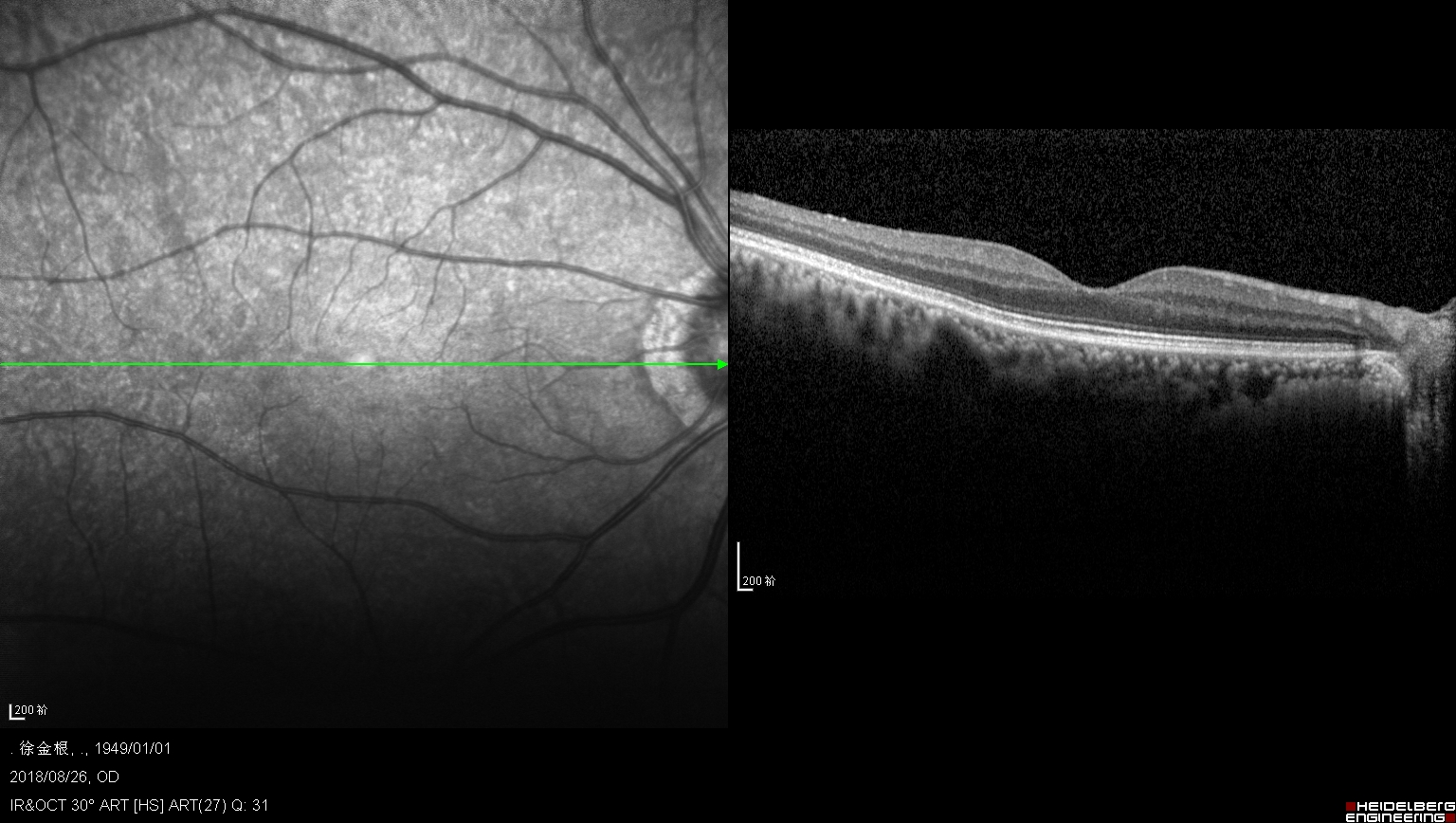 眼球晶体破洞,眼球裂缝是什么原因造成的