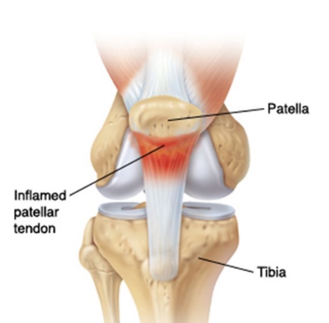 跑跳的时候一只膝盖痛,跑跳时膝盖外翻