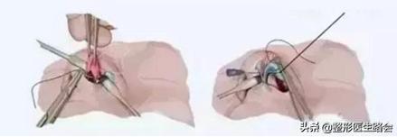 鼻翼缩小外切好吗,鼻翼缩小外切还是内切效果好