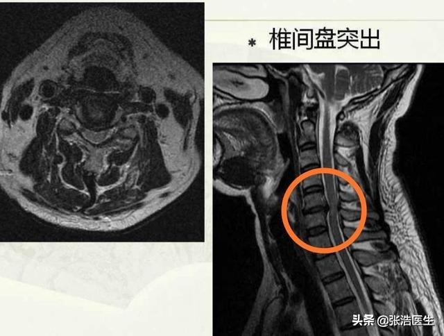 颈椎病不治疗可以缓解吗？什么情况下需要手术？
