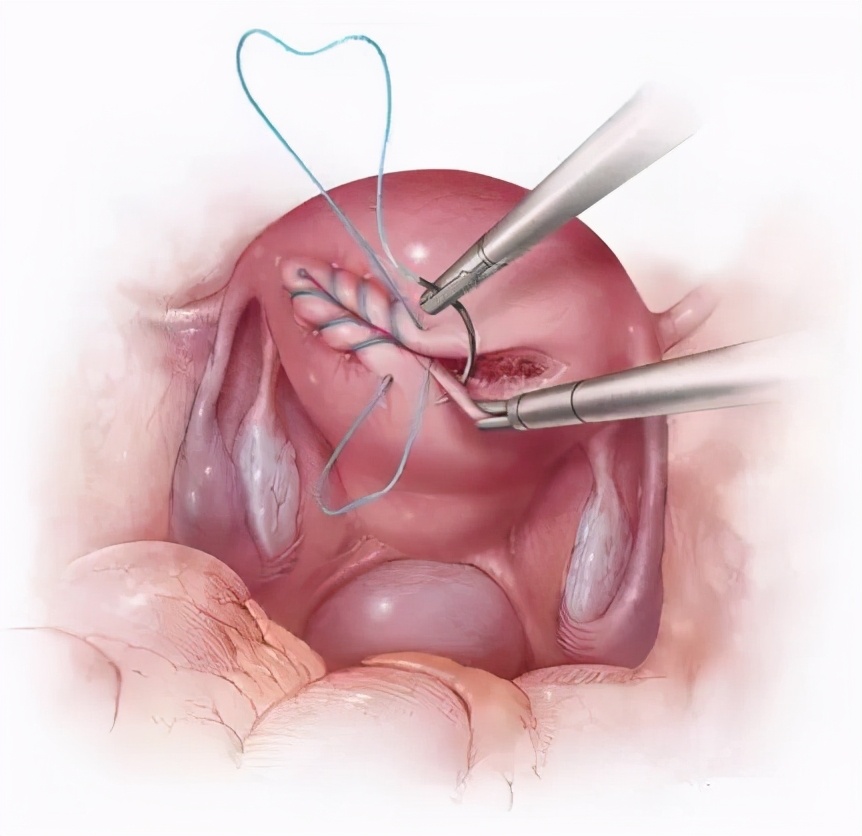 女子腹大如鼓竟是罕见病作怪,女子腹中生巨瘤肚皮肿胀如孕妇