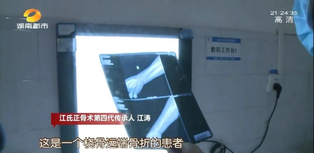 断骨手法复位视频,身怀绝技全集