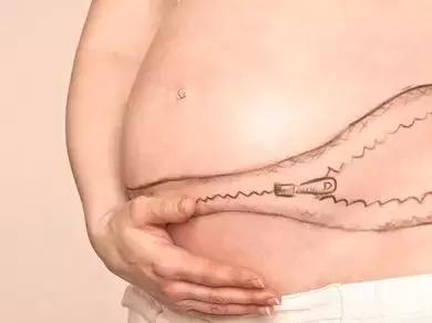 剖腹产产妇生完后要注意哪些事情,剖腹产二胎产后三天饮食注意