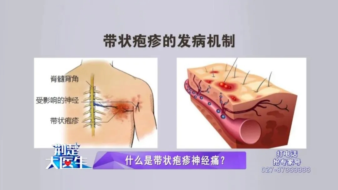 「中山医“声”」疼痛难忍？不能再忍！专家支招带状疱疹神经痛