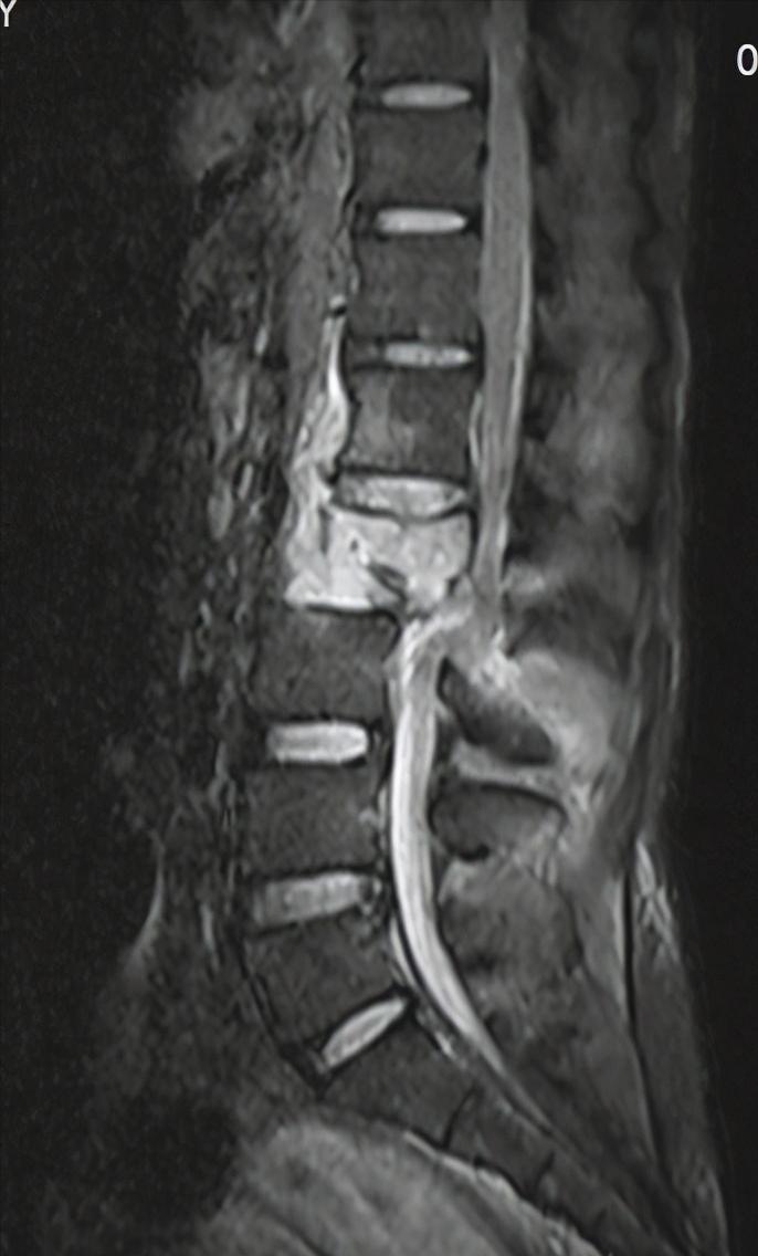 从瘫痪到重新站起来,瘫痪后重新站起来的有吗