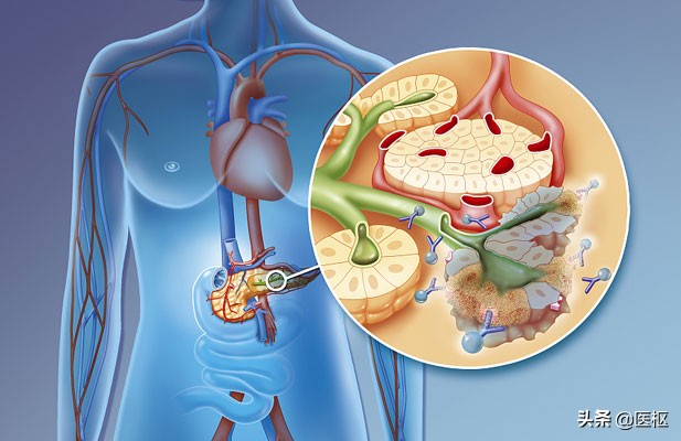 转移性胰腺癌一线治疗方案有哪些？如何选择呢？