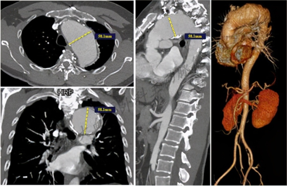 病例精选|体外开窗自制内嵌式三分支支架全腔内修复