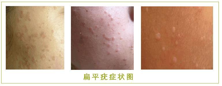 脸上有很多的小粒粒,脸上长小粒粒又不像痘痘