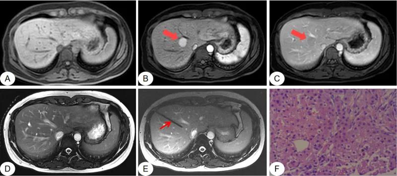 磁共振作用与效果,磁共振成像的优势有