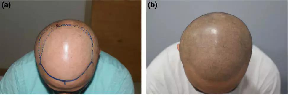 治疗秃头发的偏方有哪些,秃头吃什么偏方有效果