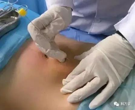 中医埋针减肥可以减肥多少斤,安康市中医医院埋线减肥