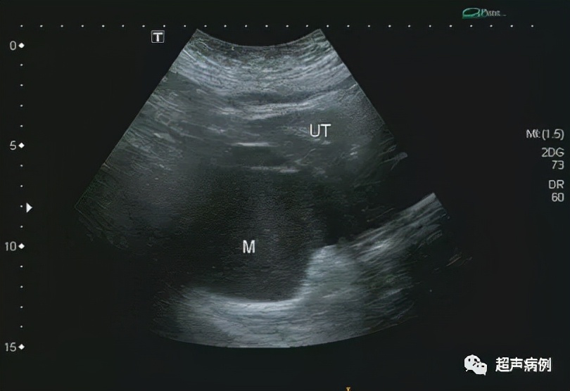 臀部包块超声检查,盆腔囊性包块10公分肚子剧痛
