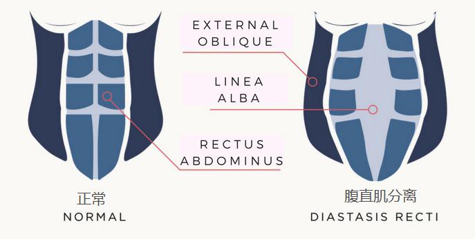什么是腹直肌分离呀,什么是腹直肌修复视频