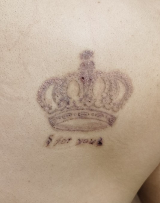 洗纹身一次比一次疼的轻吗,洗纹身一次的效果