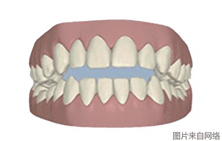 隐形矫正精细调整的流程,做隐形矫正的方案费不能退吗