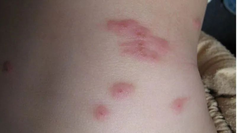 手臂起小疙瘩是荨麻疹,腿上起丘疹性荨麻疹水肿