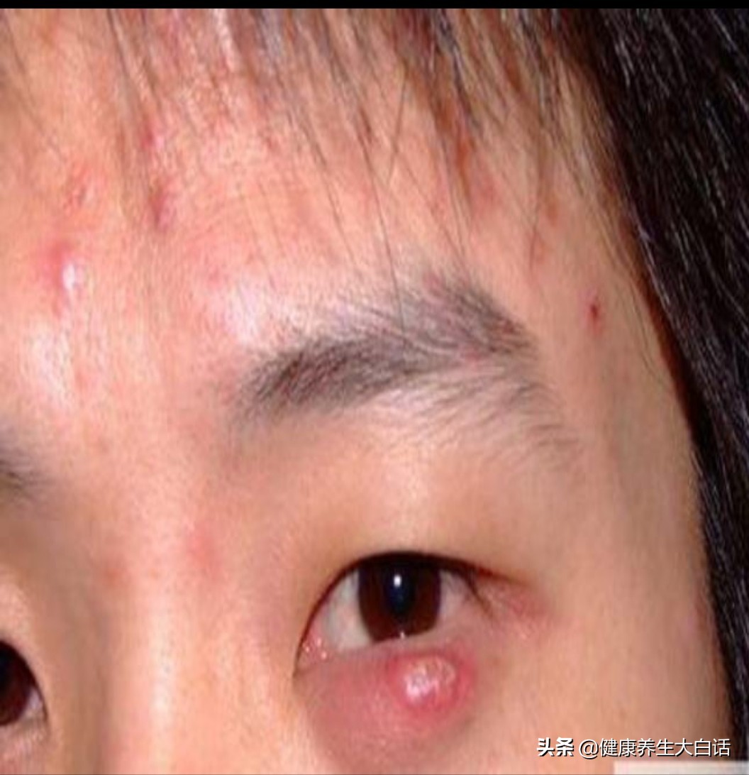 解决麦粒肿,生活小妙招麦粒肿