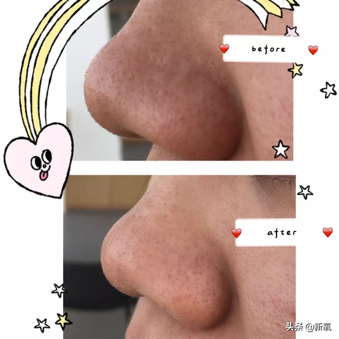 去黑头最有效的方法一个月见效,别挤了教你去黑头的正确方法