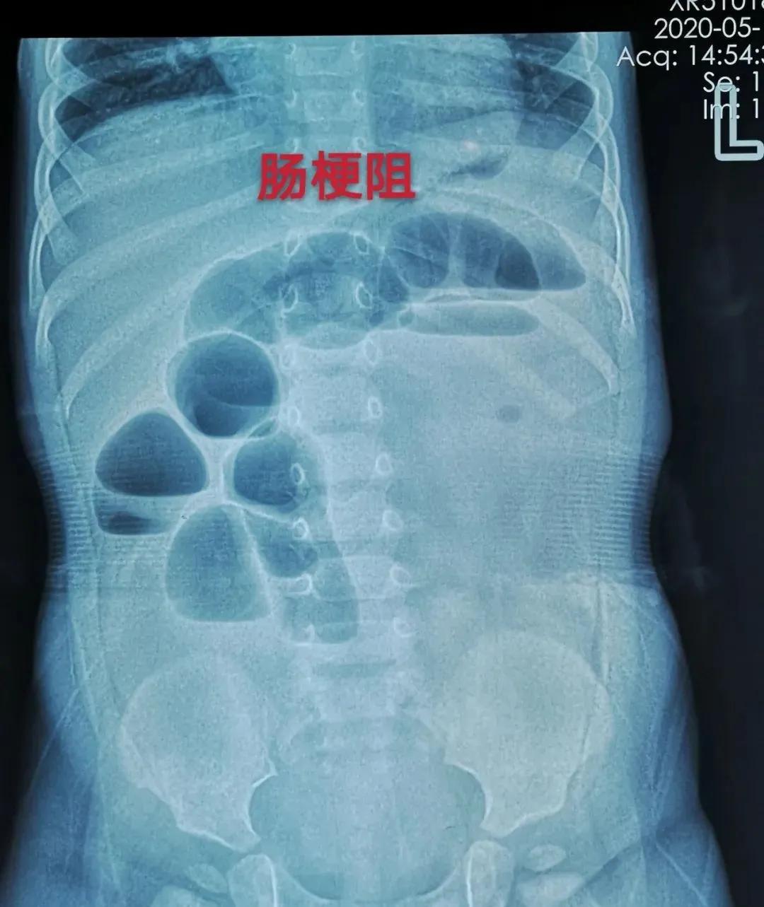 1岁孩子腹胀不排便，呕吐黄绿色液体！医生：是这种玩具导致的