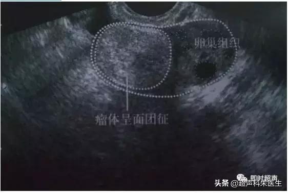 妇科超声的标准超声图,妇科超声图解