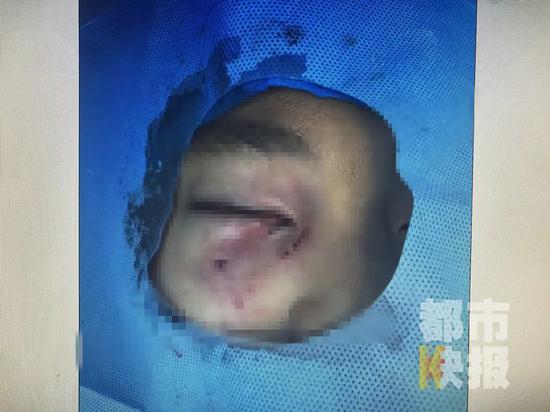 男童被大型犬抓伤,男童遭大型犬咬伤在icu抢救