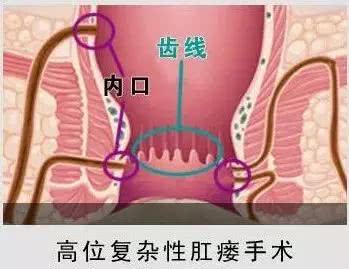 肛瘘应该怎么办不做手术可以吗,肛瘘长到睾丸附近不做手术行吗