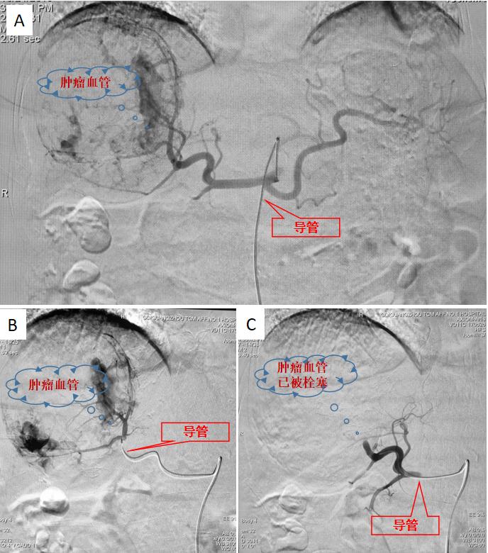 患癌必死无疑？错！善用介入疗法，恶性肿瘤患者长期生存不是梦
