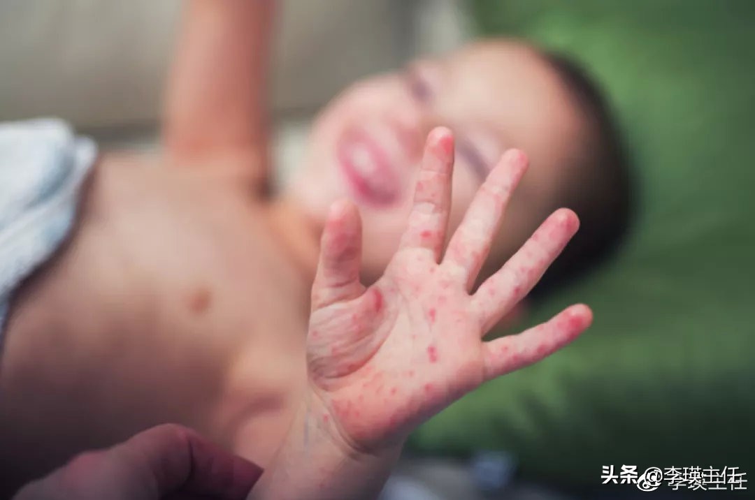 手足口病和水痘最明显的区别,手足口病和水痘怎么区分