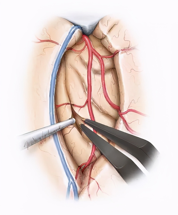 岛叶胶质瘤手术是开颅还是微创,岛叶良性胶质瘤复发率