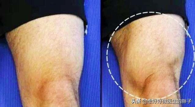 小腿腓骨骨折保守治疗多久能走路,小腿骨折保守治疗多久能恢复正常