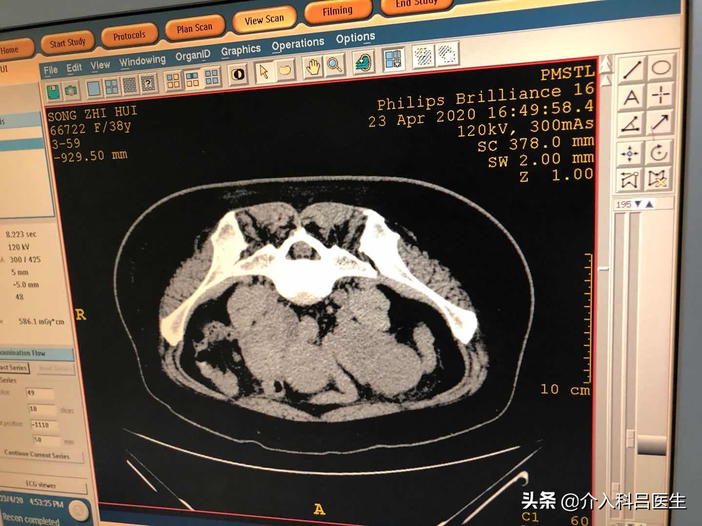 一根针治疗卵巢囊肿手术石家庄,一根针无痛消融子宫肌瘤