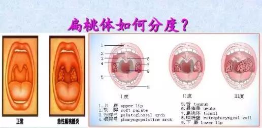 肾病扁桃体,肾病患者扁桃体发炎怎么办