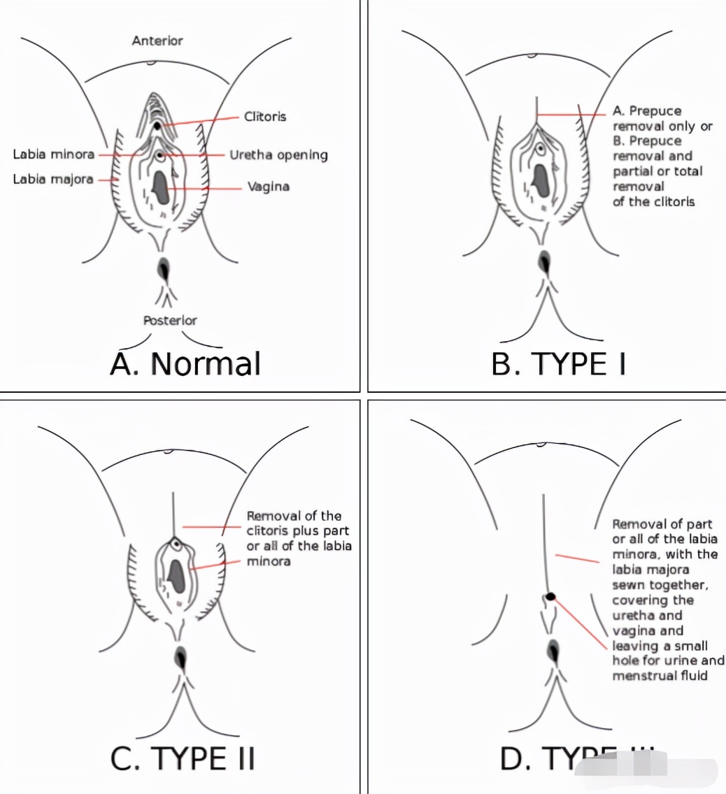 上亿女性的噩梦：割礼，这残忍至极的陋习，要卷土重来了？
