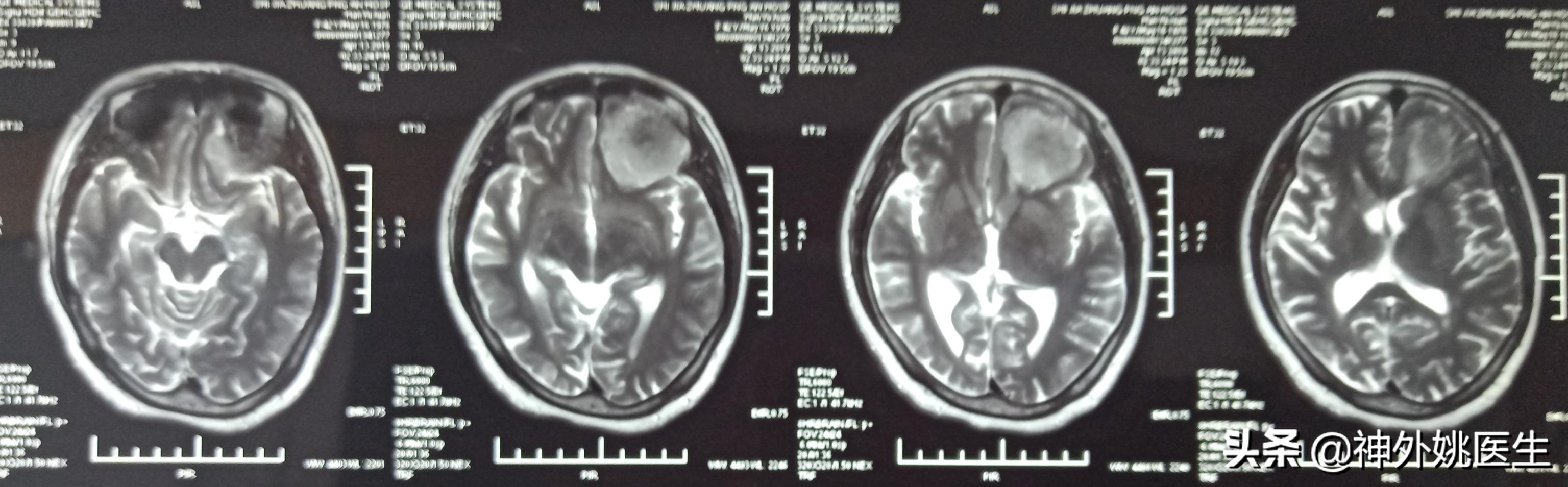 脑膜瘤是什么原因引起的啊,脑膜瘤手术治疗全部大概多少钱