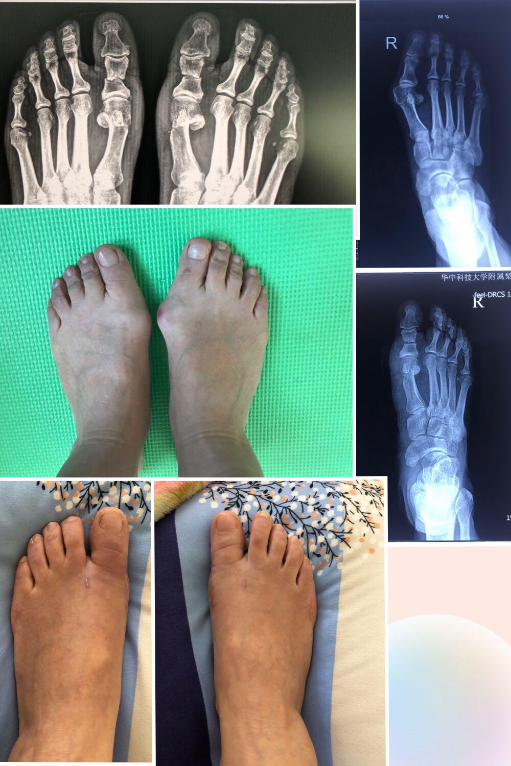 拇外翻微创手术的全过程,医生自己给自己做拇外翻手术