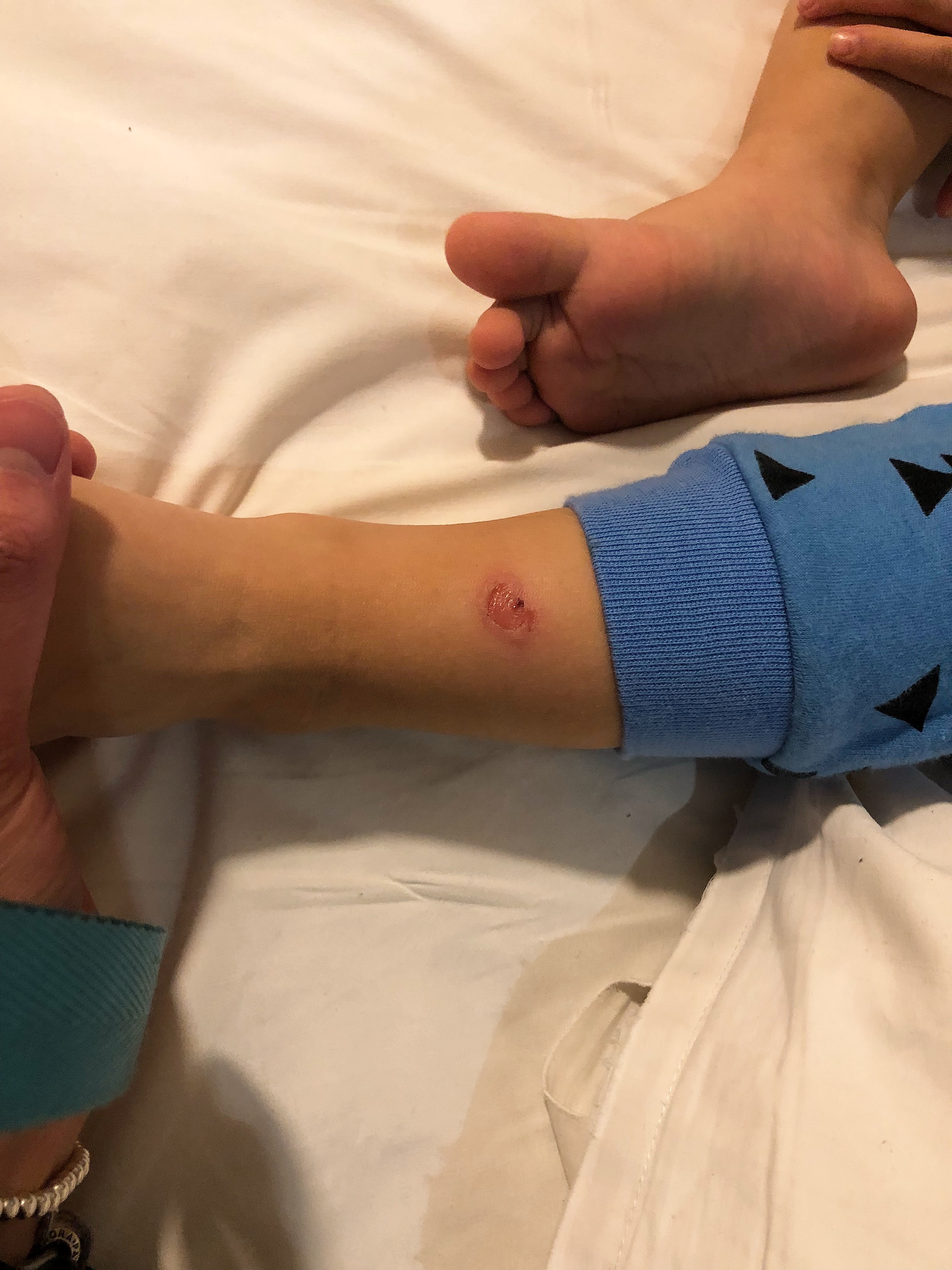 小儿白塞氏病的病因和症状,肉丸子得了什么病