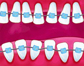 牙齿黑三角要及时修复吗,牙齿黑三角自愈图片