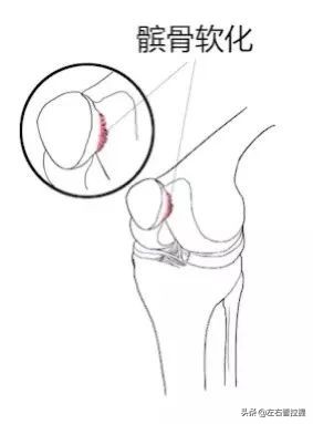 膝关节置换后的康复锻炼方法视频,膝盖痛锻炼膝盖的正确方法